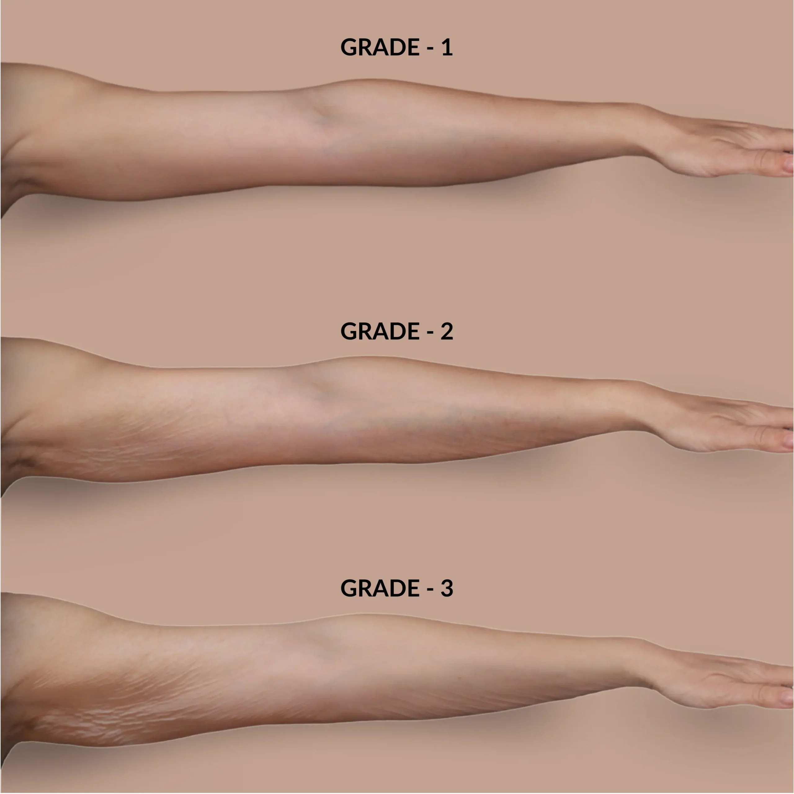 Profhilo - Comparison Arm