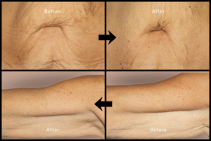 Before after Profihlo