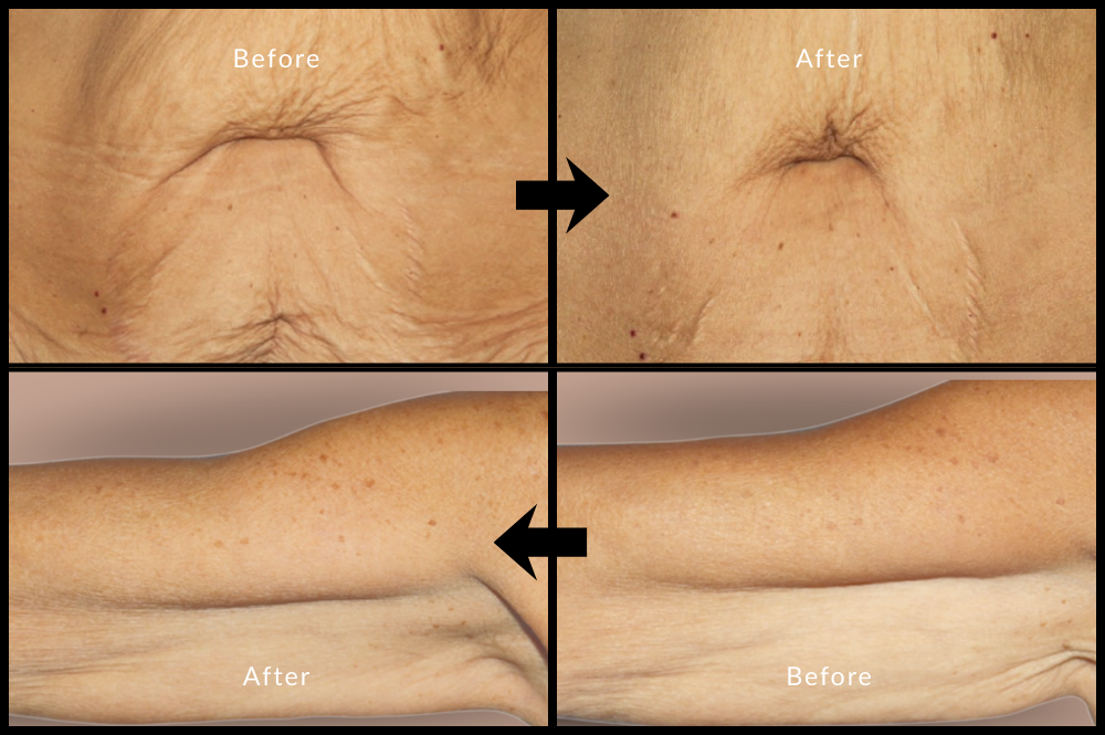 Before after Profihlo